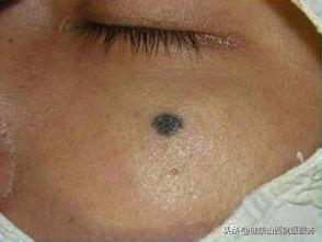 激光点掉的痣会恶变吗,激光点痣会诱发痣癌变是真的吗