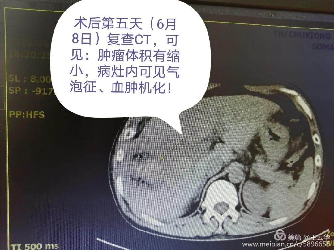 楚雄州人民医院肝胆外二科,四川省人民医院肝胆外科治疗肝癌