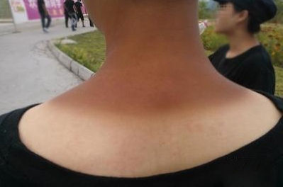 夏天晒黑怎么恢复美白,夏天晒黑了怎么快速变白