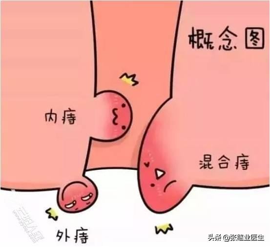 小痔疮大隐患,小痔疮用啥药