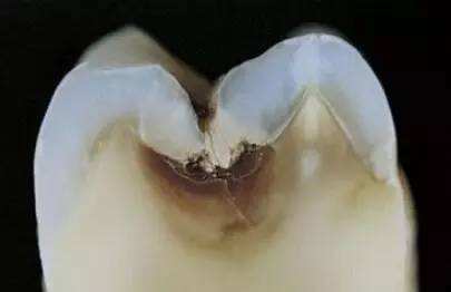 牙齿发黑发黄怎么快速去除,牙齿突然发黄发黑牙龈出血