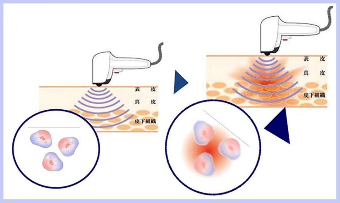 痘印痘坑目前治疗方法哪个最好,医美机构靠药物去痘印痘坑可靠吗