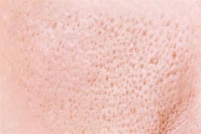 微针美容是否适合你一份详细指南,毛孔粗痘坑用什么微针精华