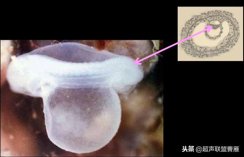 内见卵黄囊,卵黄囊肿瘤