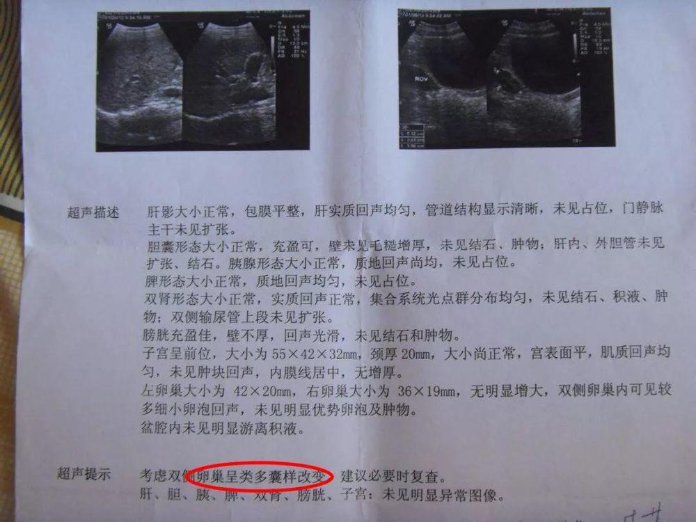 B超出现“卵巢多囊”4个字，就一定是多囊卵巢综合征？该怎么办？