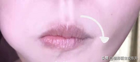 法令纹严重怎么办30岁,中年人怎么去除法令纹